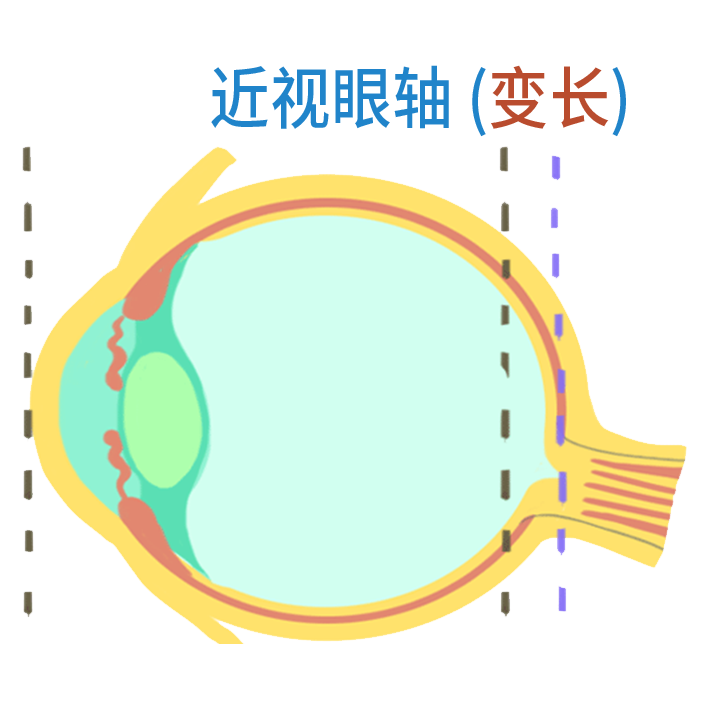 儿童眼轴最新进展，守护明亮的未来，关注孩子视力健康👀